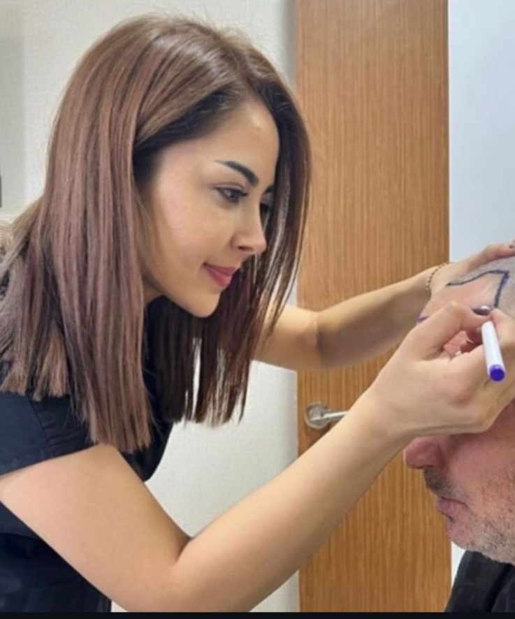 revo-hair-transplant-2