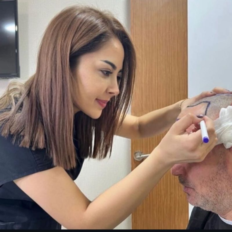 revo-hair-transplant-2