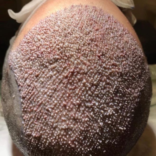 revo-hair-transplant-3